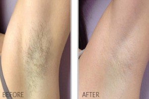 Treatments For Facial Hair  Laser Hair Removal  Procedure  Precautions   YouTube