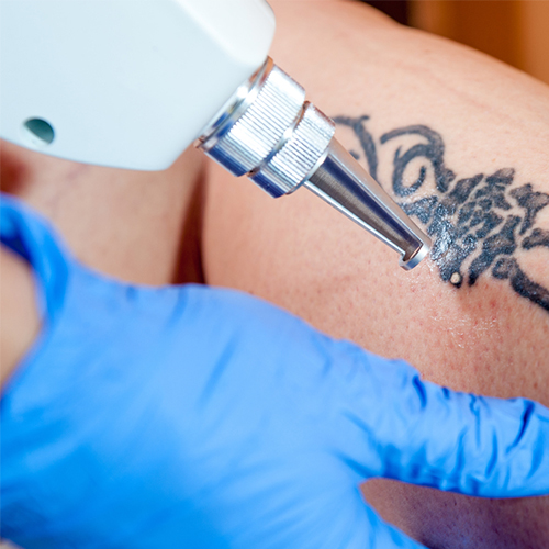 Tattoo Removal in Allahabad, Laser Tattoo Removal | Cosmetic Mantra